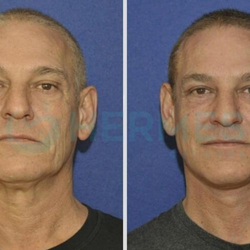 Wrinkle treatment Before / After photo